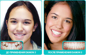 брекеты Damon до и после