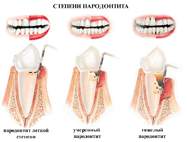 пародонтит